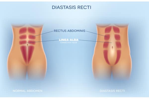 What Non-Surgical Options Are Available for Diastasis Recti Staines?