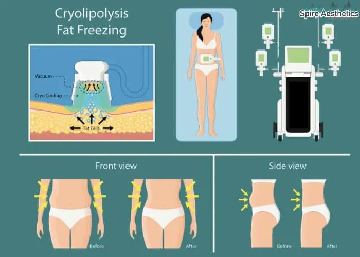 Fat freezing treatment Staines benefits for competitions to remove stubborn fat deposits.
