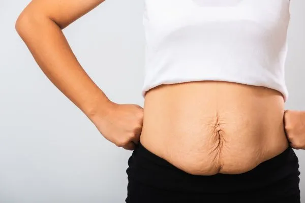 Image of a woman's stomach after weight loss with sagging skin following a gastric band Staines