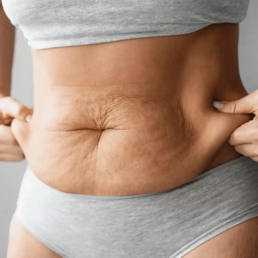 Is It Normal to Have Loose Skin After Pregnancy Staines?