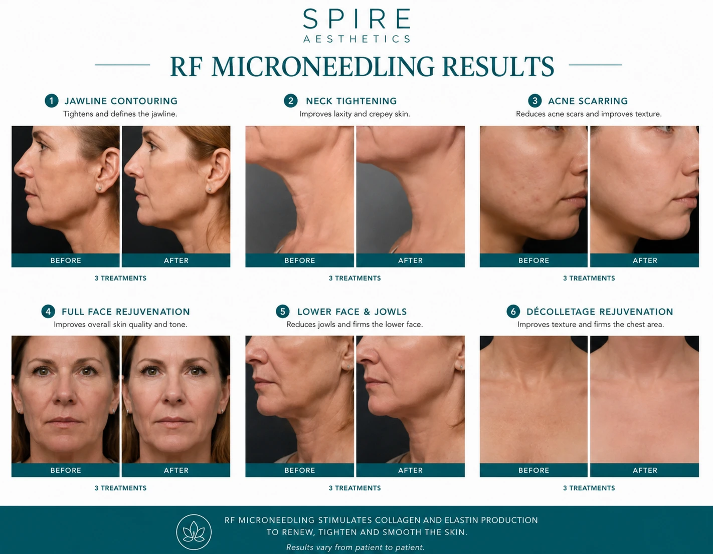 RF Microneedling Skin tightening Staines results