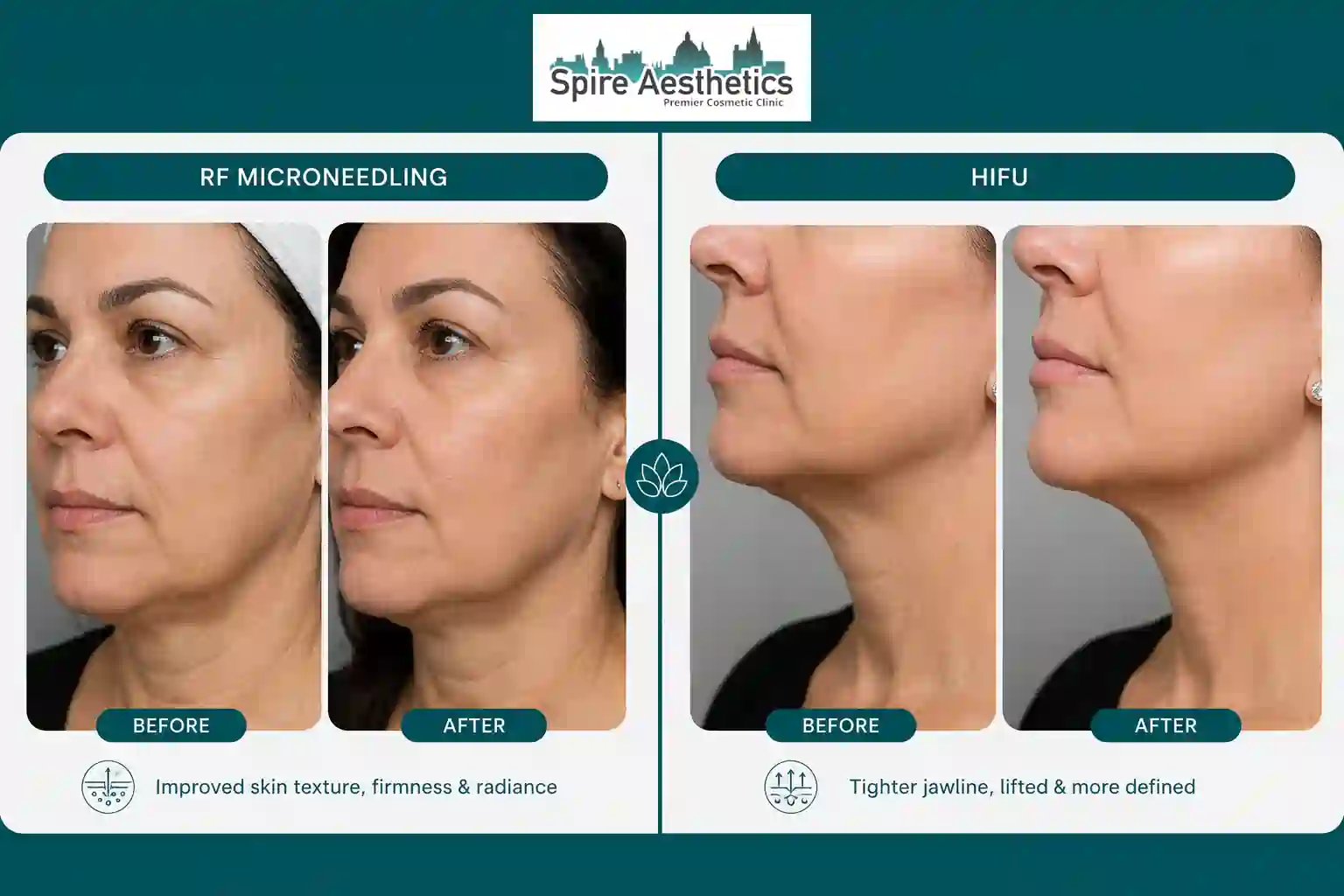 Can RF Microneedling and HIFU Be Combined Staines?