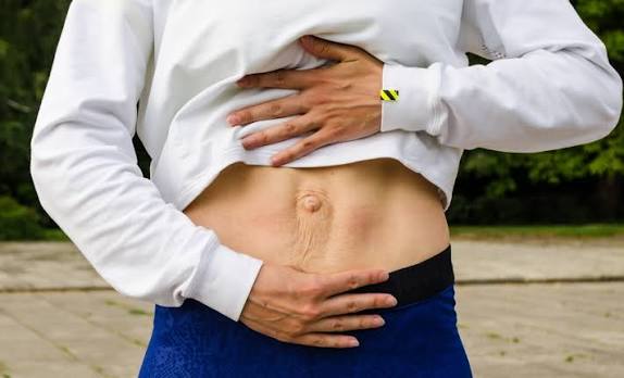 When Could Diastasis Recti Be the Missing Piece of the Puzzle Staines?