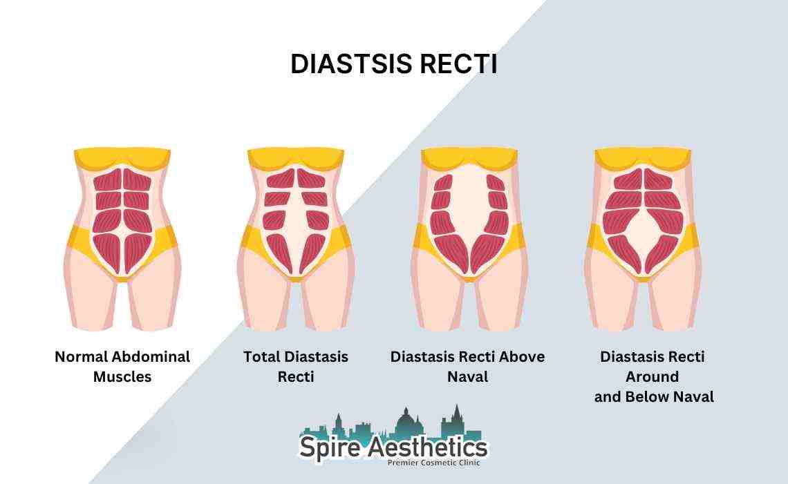 Is Non-Surgical Diastasis Recti Treatment Right for You? Common Concerns Answered Staines
